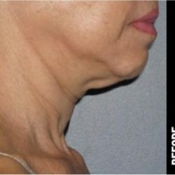 Ultherapy Before & After Patient #1555
